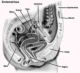 Endometriose superficial